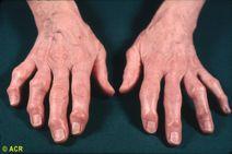 Case 2 59 year old woman Notes that her knuckles are changing shape over the past several years Difficulty