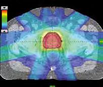 treatment options are limited or conventional radiotherapy presents an unacceptable risk to the patient.