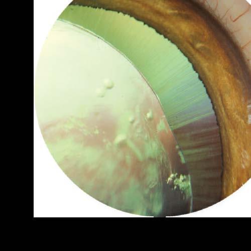 Lens Luxations primary (typically Terriers) secondary due to glaucoma chronic uveitis neoplasia trauma ageing may be seen as
