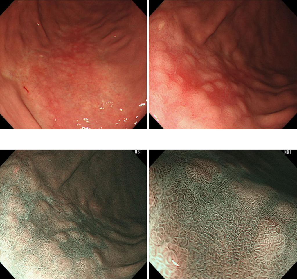 a b c d Figure 1. (a, b) Endoscopy revealed a large reddish depressed lesion in the greater curvature of the middle to lower corpus of the stomach.