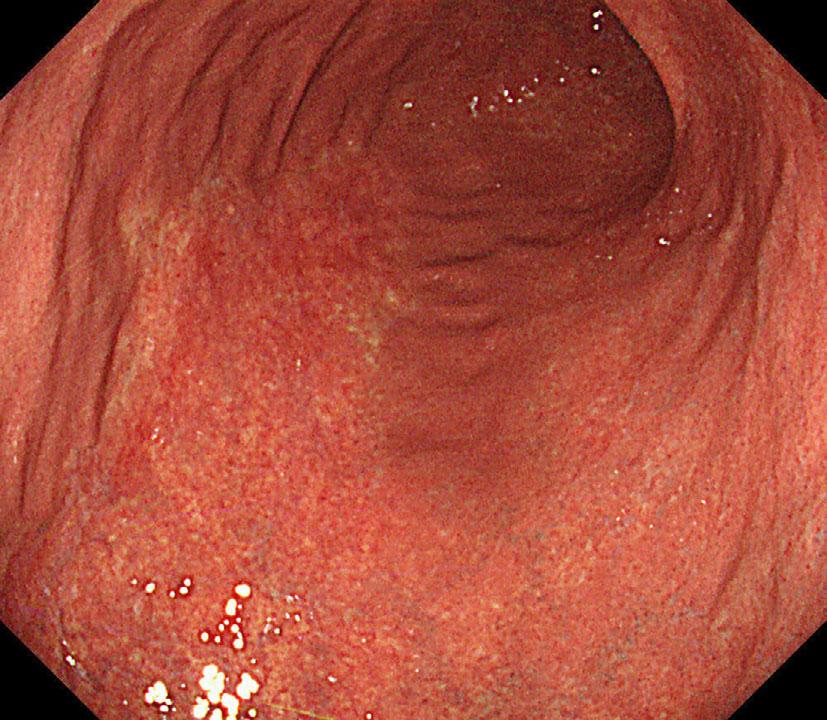 Focal small vascular congestion was also observed in the mucosa. Neither centrocyte-like (CCL) cells nor lymphoepithelial lesions (LELs) were observed (Hematoxylin and Eosin staining).