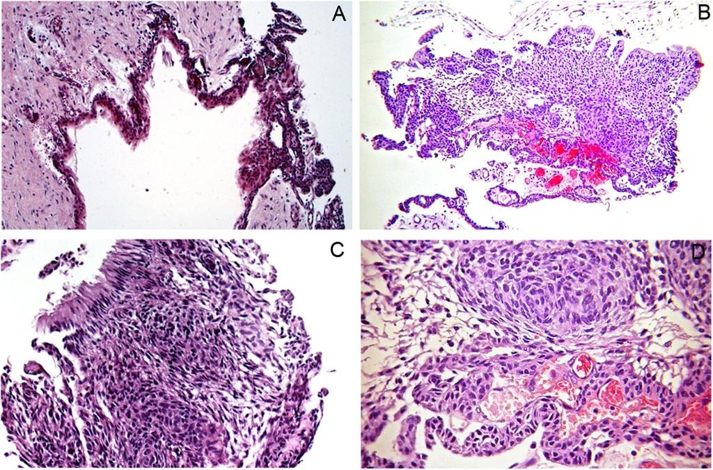 Discussion The present report describes a cystic lesion characterized histologically by the presence of an AOT associated with an odontoma.