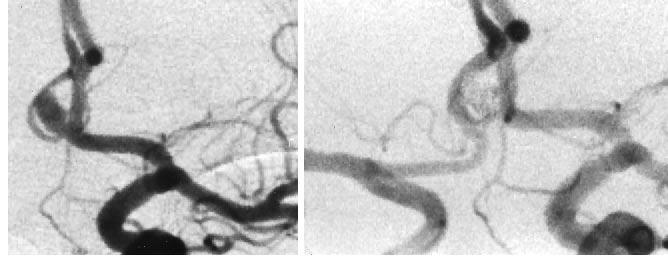 Early treatment of SAH after prevention of rerupture FIG. 2. Case 5. Left: Prethrombosis angiogram, anteroposterior view, showing the ruptured anterior communicating artery aneurysm.