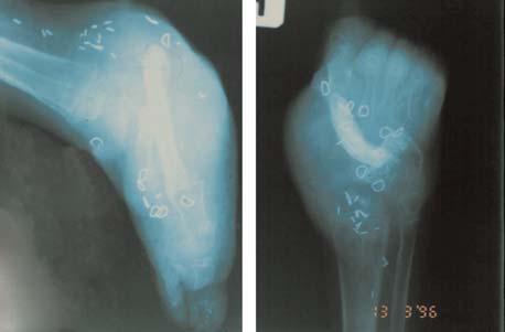 The early results of the use of the fibula graft for the tibia appeared satisfactory.