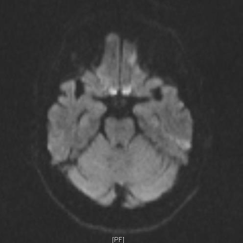 Diffusion Weighted MRI Study Example of an 82-year-old