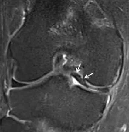 2 Coronal fat -suppressed PD -W MR image taken at the level of the intercondylar notch. CASE PRESENTATION A 58 -year-old Indian man sustained a road traffic accident a few years ago.