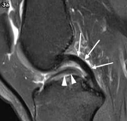 1 '!Medical Education 1 4. 3b 1. Fig. 3 a) Double-PCL sign in a 27 -year -old man with a displaced bucket -handle tear of the medial meniscus.
