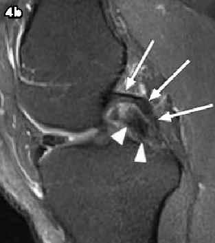(b) Midline sagittal fat -suppressed PD -W MR image taken at the level of the intercondylar notch shows a displaced bucket -handle fragment (arrowheads) located anterior to the PCL (arrows).