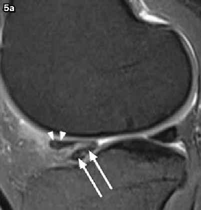 !Medical Education 5a 5b 14. o -5i V o 1.6 ti 6 Cl p Fig. 5 Anterior flipped meniscus sign in 27 -year -old man with a displaced bucket -handle tear involving the body of the lateral meniscus.
