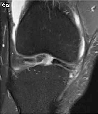 (b) Axial fat -suppressed PD -W MR image shows a large curvilinear displaced fragment (arrowhead) located adjacent to the normal anterior horn of the lateral meniscus (arrows).