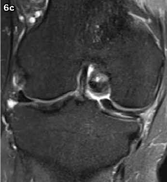 (b) On the midcoronal image, the inner fragment of the medial meniscus (arrowhead) is displaced towards the intercondylar notch (arrowhead).