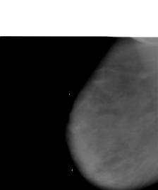 axillary tail on contrast
