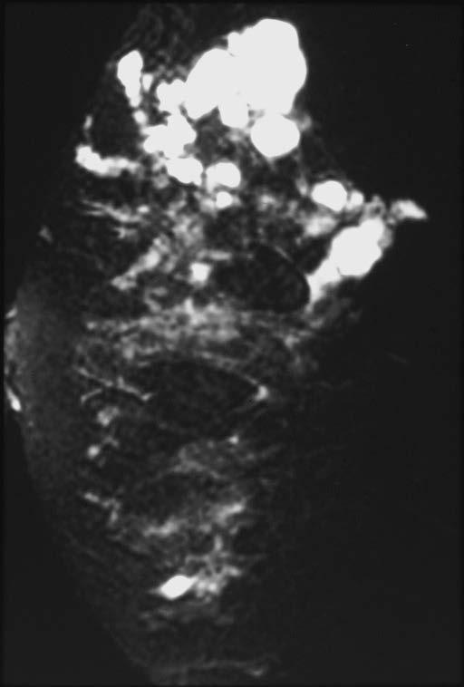 Colloid Cancer MRI