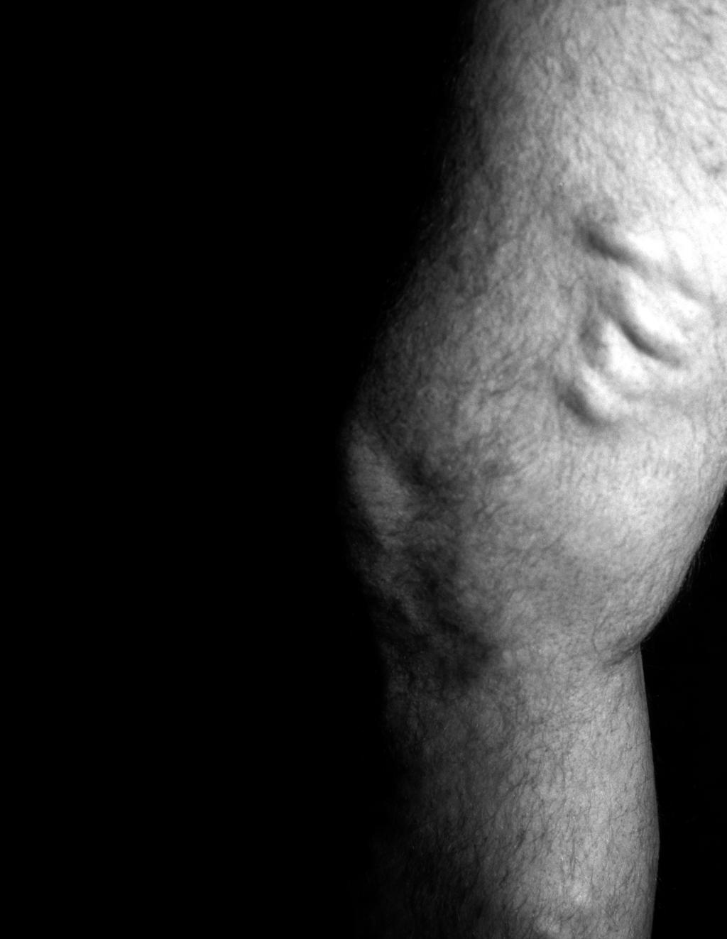 Varicose Veins Painful and unsightly varicose veins can be treated on a outpatient basis with a minimally invasive procedure called ablation.