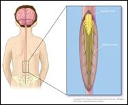 Background What is Selective Dorsal Rhizotomy (SDR)? SDR is a neurosurgical procedure (SDR) used to improve spasticity in some children with spastic diplegic cerebral palsy.