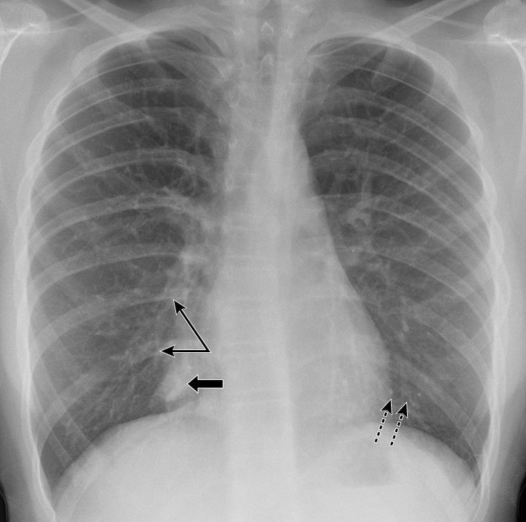 Bronchiectasis in a child ring shadows (dashed arrows)