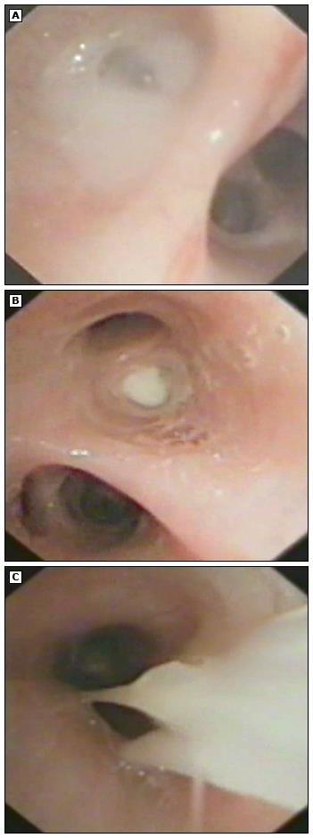 Bronchoscopy in a child with