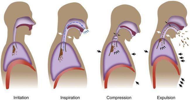 Mechanics of cough deep inspiration closure of glottis forceful contraction of the
