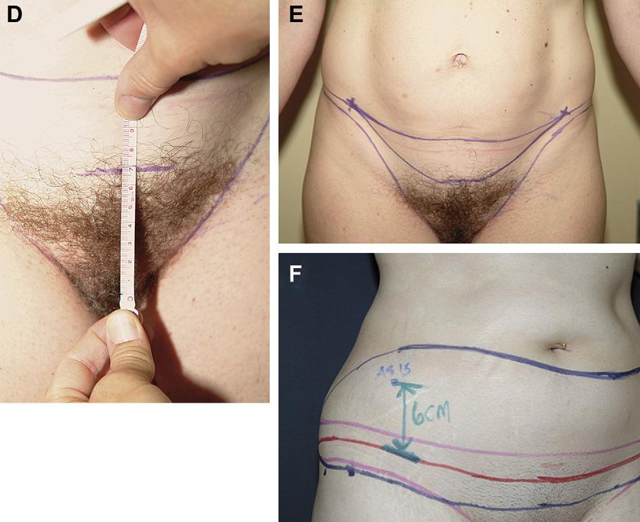 Author's personal copy High Tension Abdominoplasty 2.0 449 Fig. 6. (continued) marking to include the design of a posterior body lift that may be planned or desired in the future. 4. Define the lower margin of excision next.