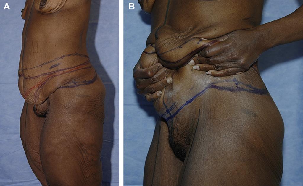 Author's personal copy High Tension Abdominoplasty 2.0 451 Fig. 8. Examination room lift. inserted.
