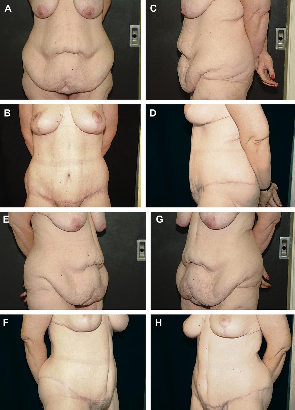 454 Rosenfield Author's personal copy Fig. 11. HTLA with liposuction of the hips and lateral thighs with breast reduction after gastric bypass surgery.