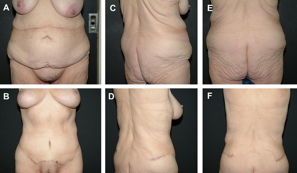 Author's personal copy High Tension Abdominoplasty 2.