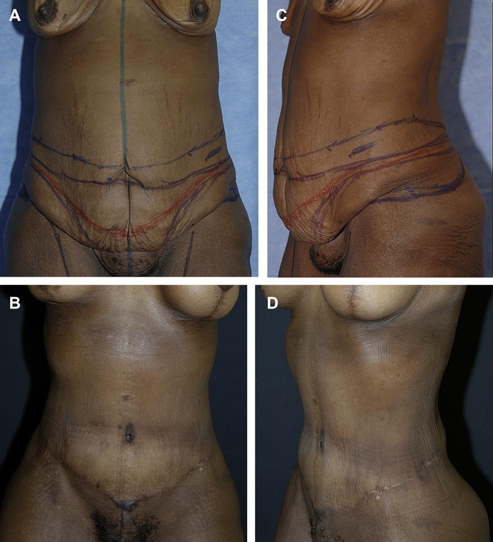 456 Rosenfield Author's personal copy Fig. 13. HTLA with liposuction of the hips and lateral thighs as well as mastopexy with implantation.