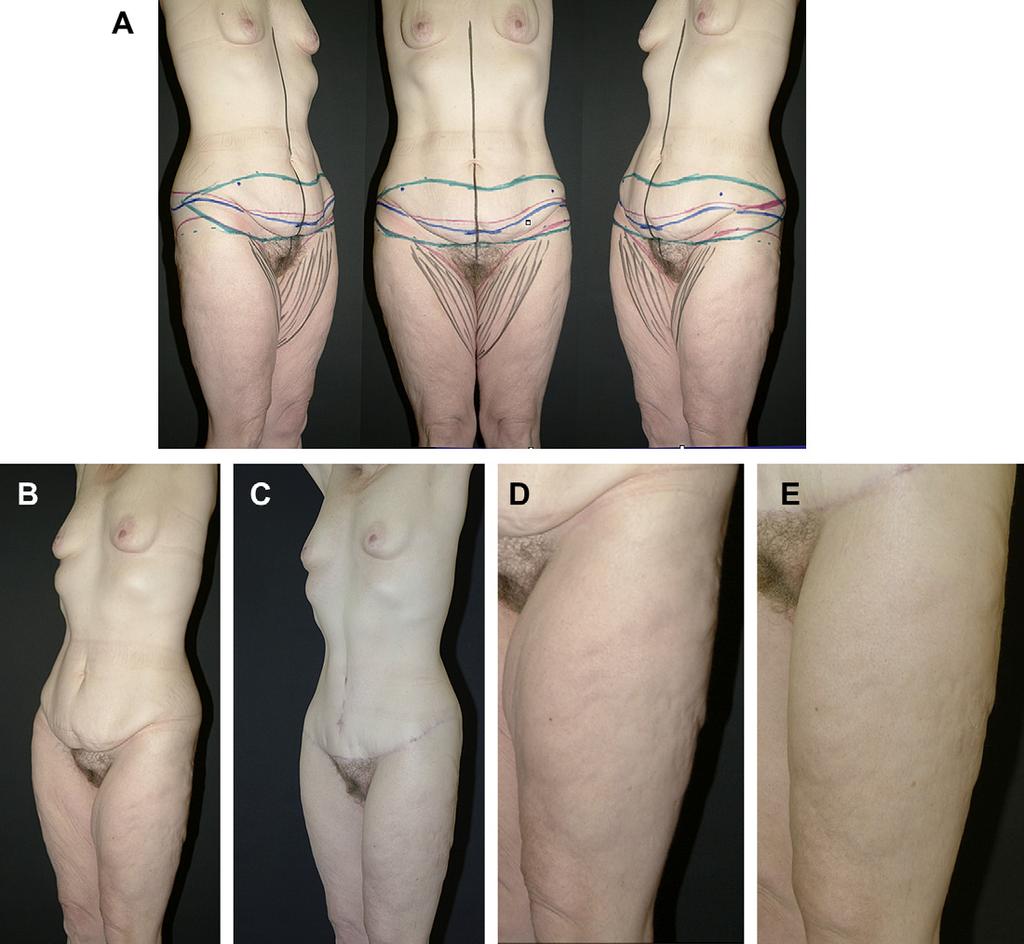 Author's personal copy High Tension Abdominoplasty 2.0 457 Fig.