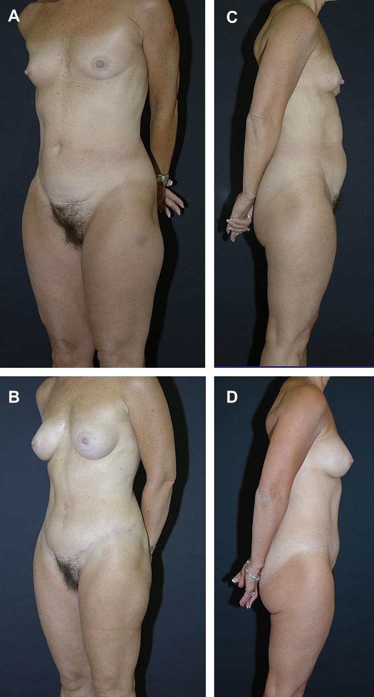 458 Rosenfield Author's personal copy Fig. 15. HTLA with liposuction of the hips and lateral thighs and augmentation mammoplasty. tolerance for complications.