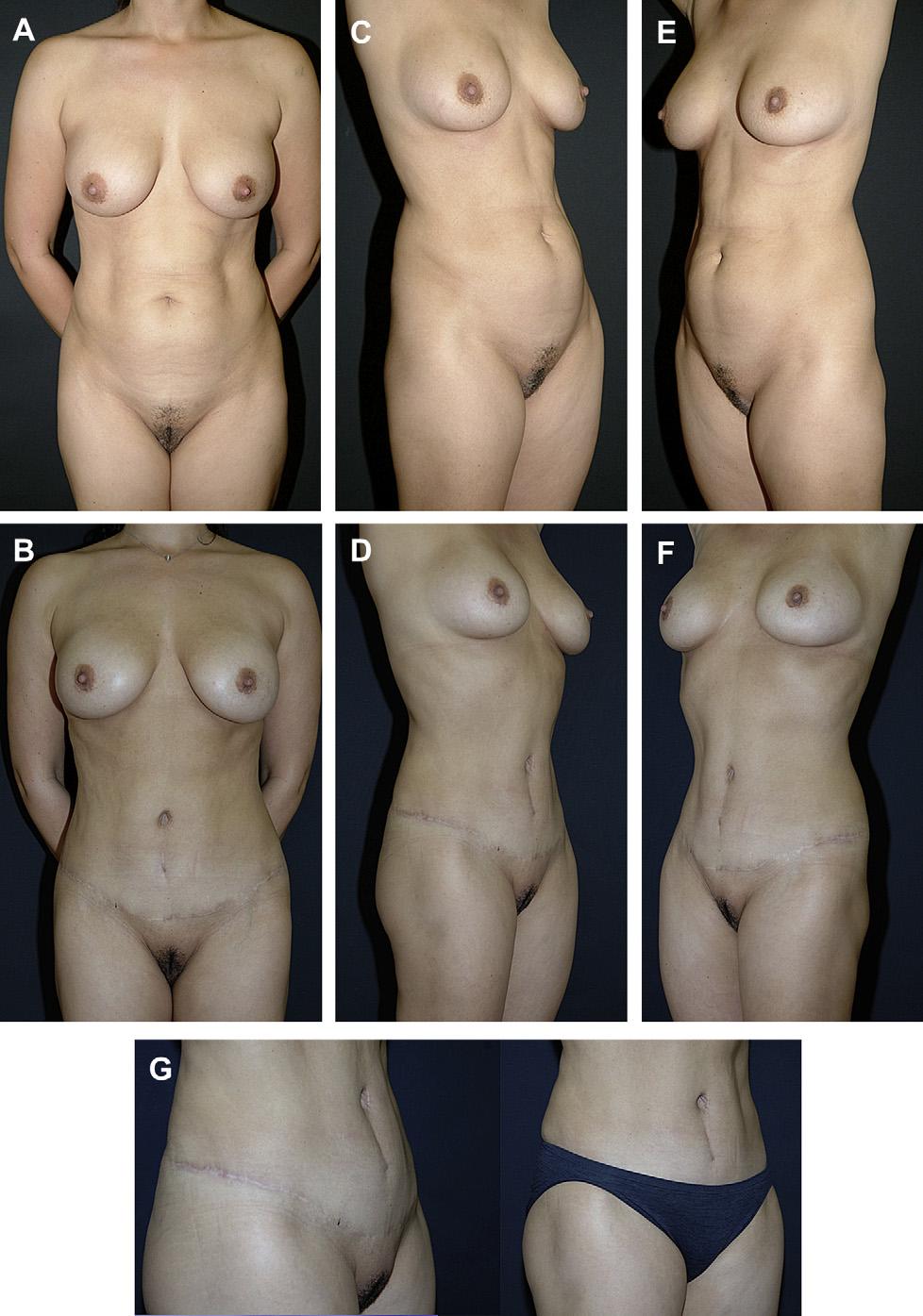 460 Rosenfield Author's personal copy Fig. 16. HLTA with liposuction of the hips and thighs. stage. However, overcorrection must be avoided by maintained a pubic width of at least 6.5 cm.