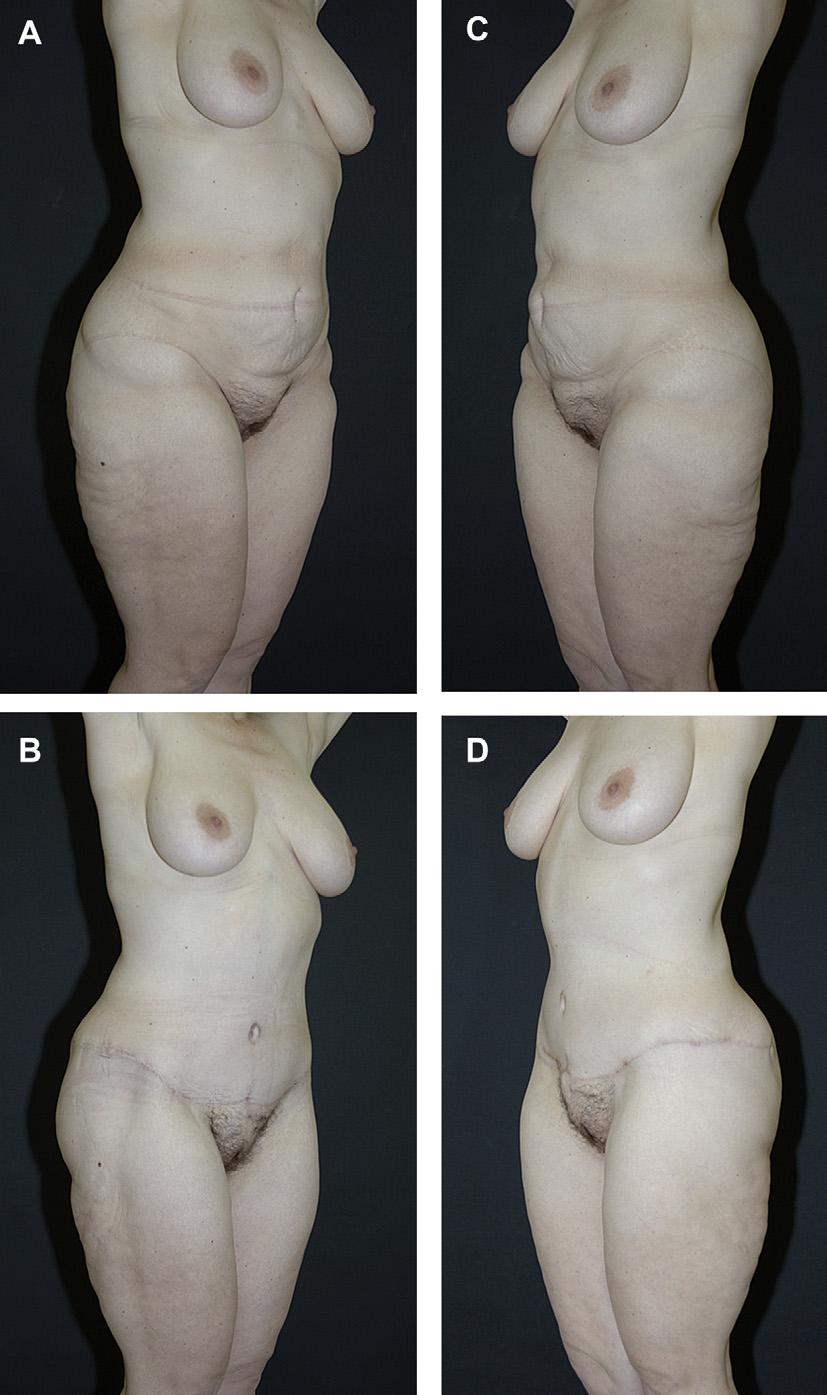 Author's personal copy High Tension Abdominoplasty 2.0 461 Fig. 17. HTLA with liposuction of the hips and thighs after gastric bypass surgery.