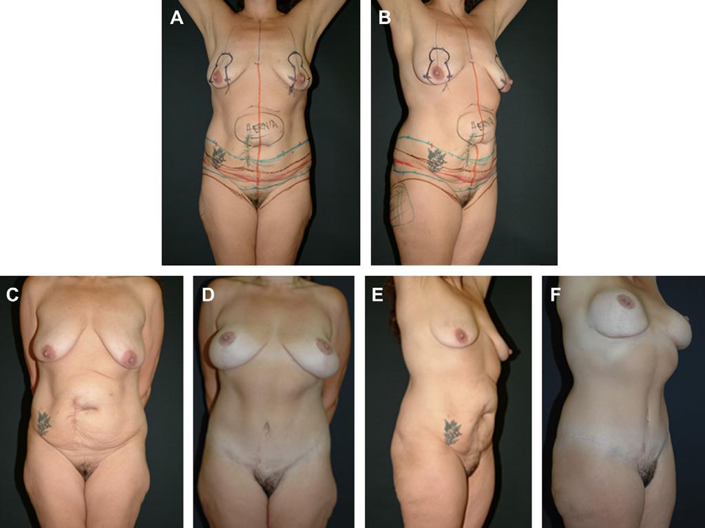 Author's personal copy High Tension Abdominoplasty 2.0 463 Fig. 19. HTLA with mastopexy/augmentation.