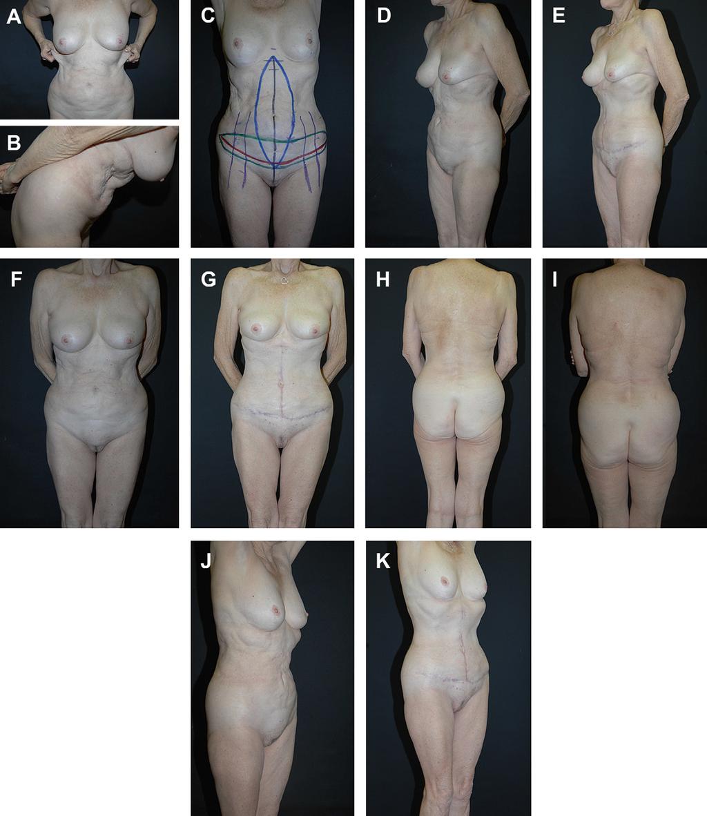 464 Rosenfield Author's personal copy Fig. 20. Fleur-de-lys abdominoplasty with a marriage to the high lateral tension principle.