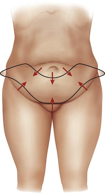 Author's personal copy High Tension Abdominoplasty 2.0 443 Fig. 1.