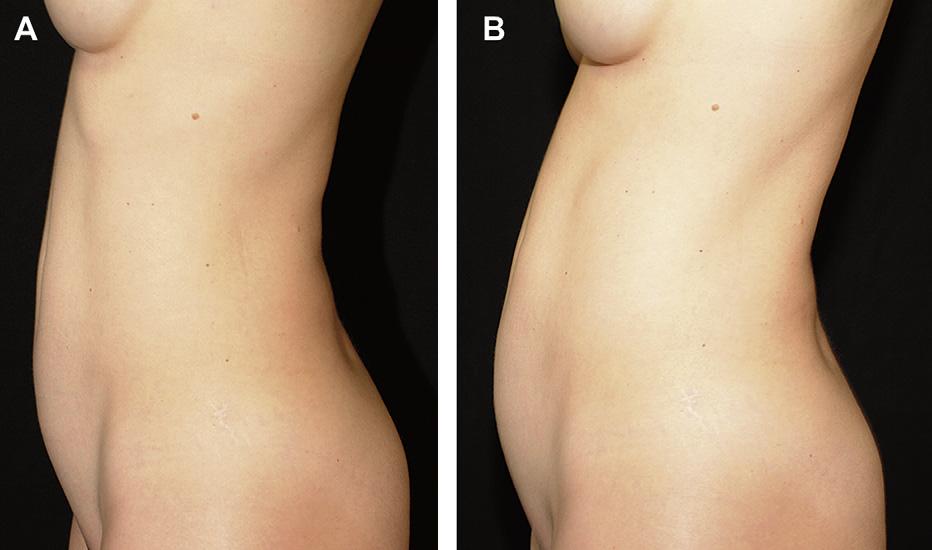 Author's personal copy High Tension Abdominoplasty 2.0 447 Fig. 5. Location and extent of protrusion. (A) Before relaxation and (B) after relaxation.