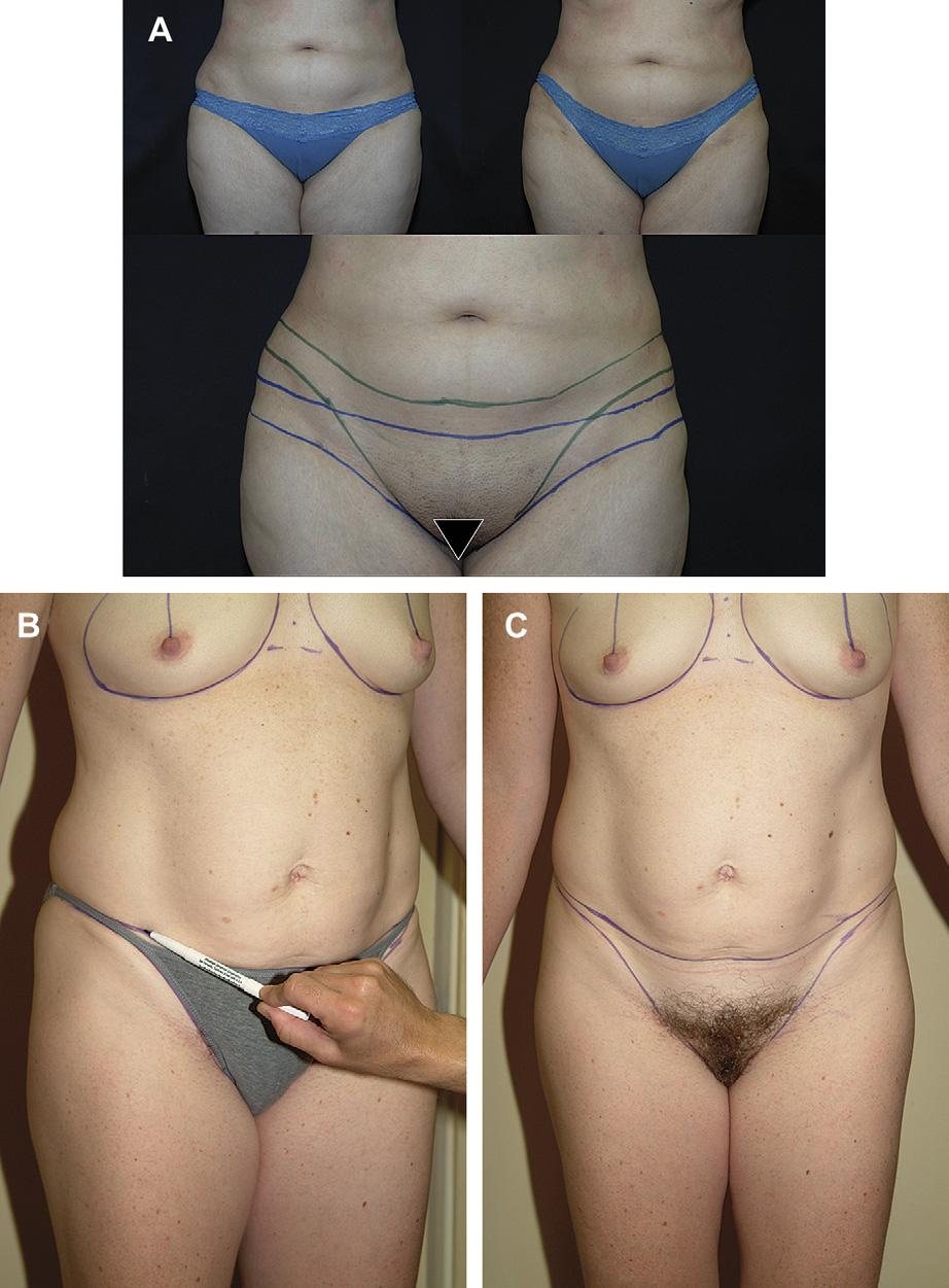 448 Rosenfield Author's personal copy Fig. 6. Patient marking within the patient s desired clothing. Suprapubic marking: Next, place a point 6.5 to 7.