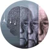 Alzheimer s disease (AD) AD is neurodegenerative disorder and most common