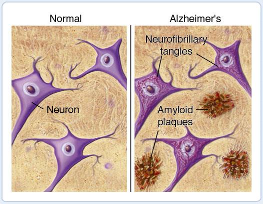 AD - molecular mechanisms (II) Senile plaques extracellular amyloid deposits Neurofibrillary tangles amyloid
