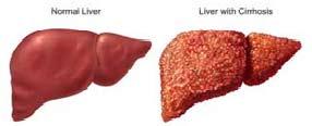 Support Vector Machine Used for Analysis Texture of Cirrhosis Liver 1 Karan Aggarwal, 2 Hardeep Singh Ryait 1,2 BBSBEC, Fatehgarh Sahib, Punjab, India Abstract Diagnostic ultrasound is a useful and