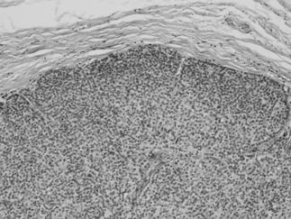 sialoblastoma Slowly growing, long standing mass Basal cell adenocarcinoma