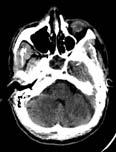 Repeat CT and CT Angiogram MRI Brain Patient expired