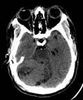 Regents UC Regents Basilar Artery Thrombosis CT Brain