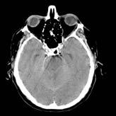 Case (con t) CT Brain 24 hours later Patient discharged from the ED BIBA 24 hours later after respiratory arrest at home, now in coma Needs immediate surgical decompression Mannitol 1gm/kg now