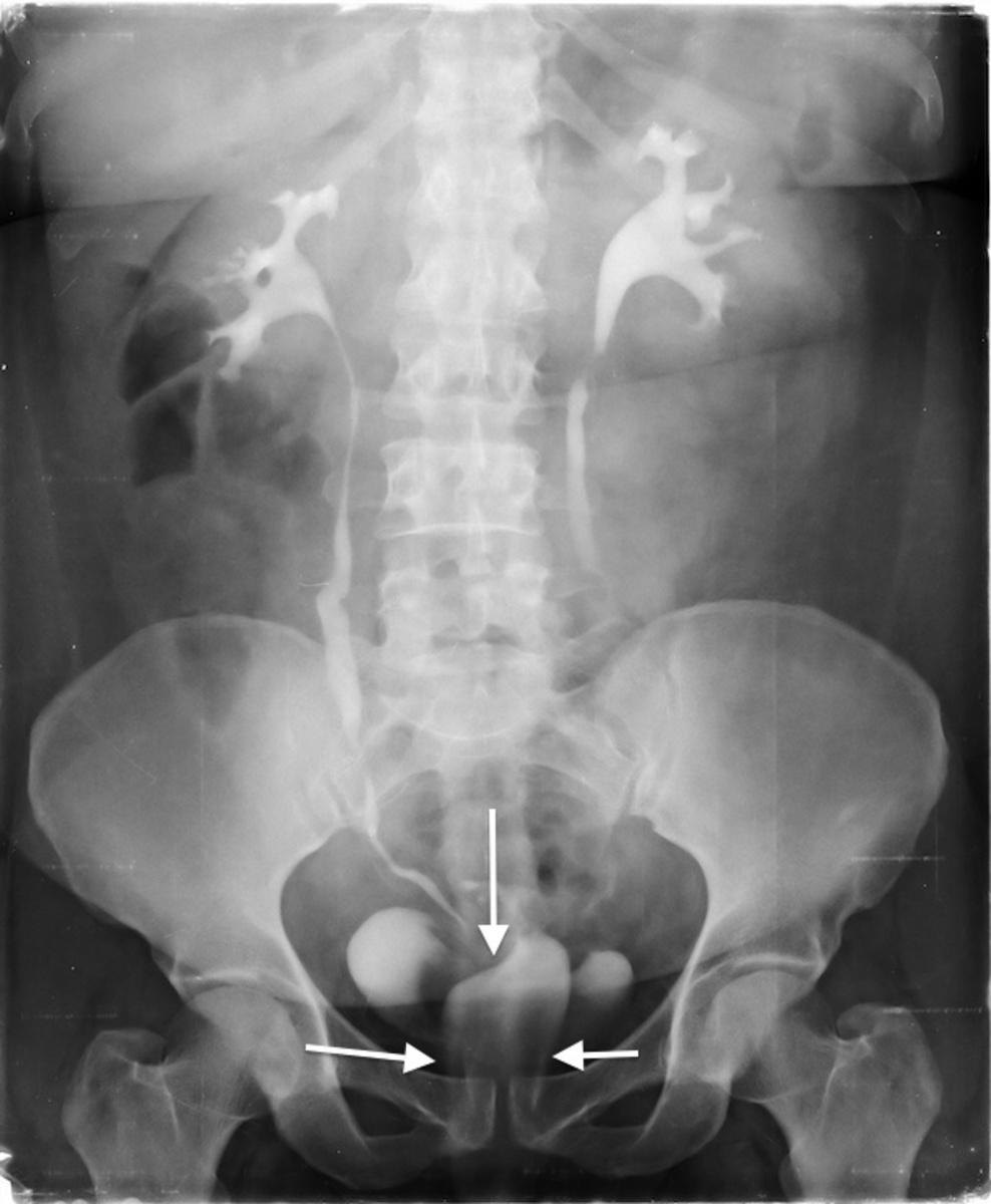 Images for this section: Fig. 7: 39-years-old female patient underwent abdominal hysterectomy since 3 years for multiple fibroids.