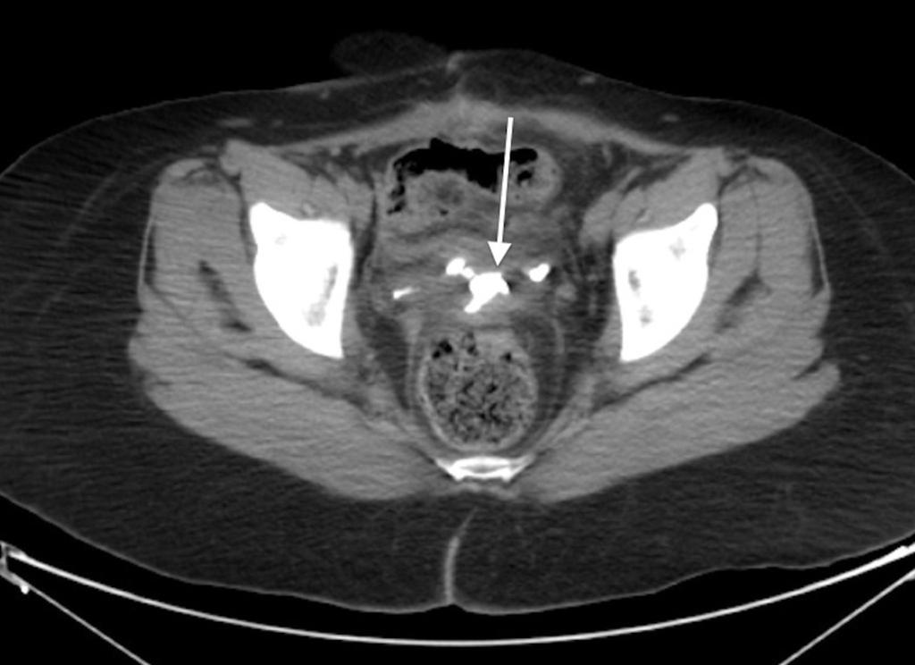 Fig. 9: CT shows contrast medium leakage in the pelvis