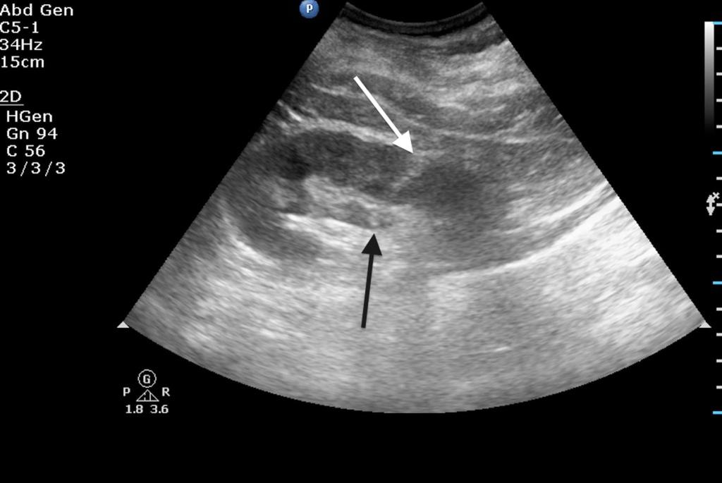 Fig. 10: Ultrasound guided left pyelocalyceal system targeting with 20G long needle