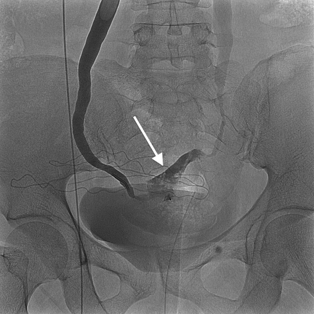Fig. 11: Left ureterography shows pelvic