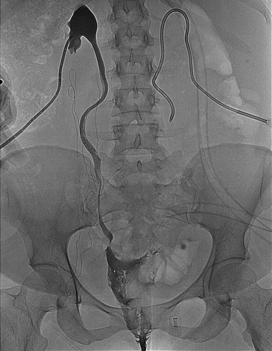 Fig. 5: Ureterography 5 days later shows still there is still ureterovaginal fistulous
