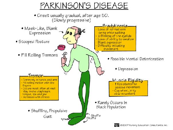 Parkinson s Disease Characterised by: tremor muscular rigidity bradykinesia