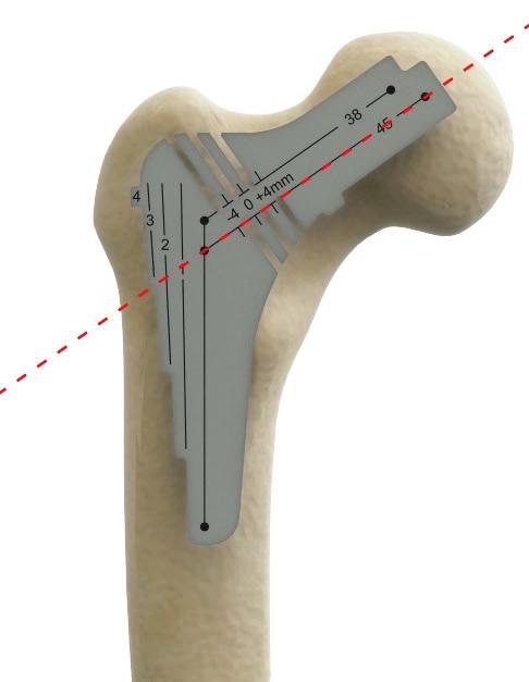 Femoral Head Resection Resection cutouts Head centres Stem sizes Central axis of the stem The centre of